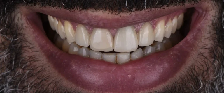 Crowns-and-Veneers-1
