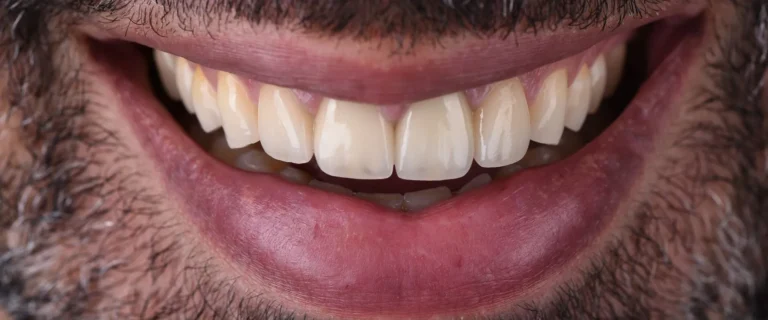 Crowns-and-Veneers-2