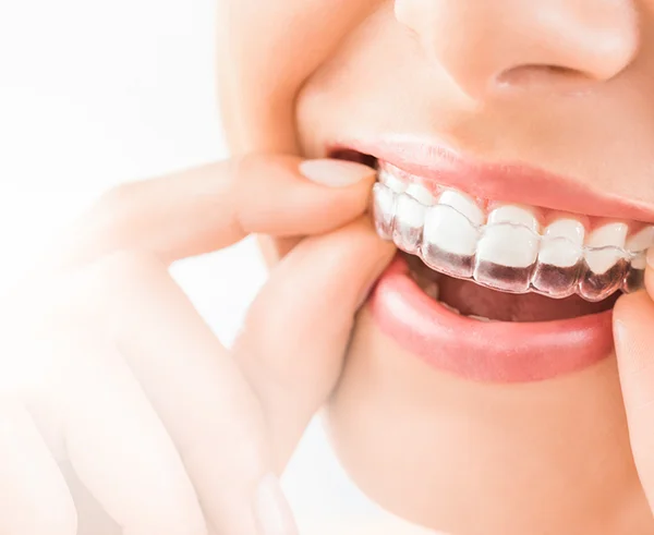 invisalign thumb1